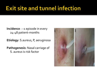 Infections in peritonial dialysis | PPTX