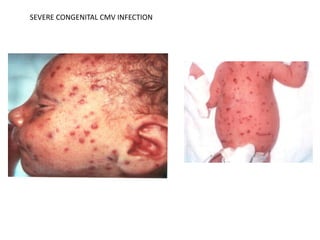 Infections in pregnancy, foetus and neonates | PPTX
