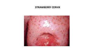 Infections of female genital tract | PPTX