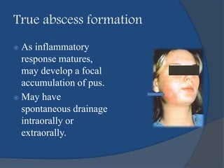 True abscess formation
 As inflammatory
response matures,
may develop a focal
accumulation of pus.
 May have
spontaneous drainage
intraorally or
extraorally.
 