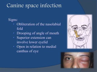 Canine space infection
Signs:
• Obliteration of the nasolabial
fold
• Drooping of angle of mouth
• Superior extension can
involve lower eyelid
• Open in relation to medial
canthus of eye
 