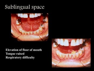 Sublingual space
Elevation of floor of mouth
Tongue raised
Respiratory difficulty
 