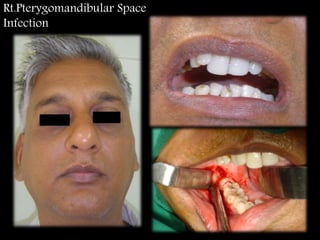 Rt.Pterygomandibular Space
Infection
 