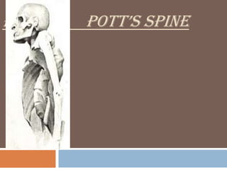 POTT’S POTT’S SPINE
 