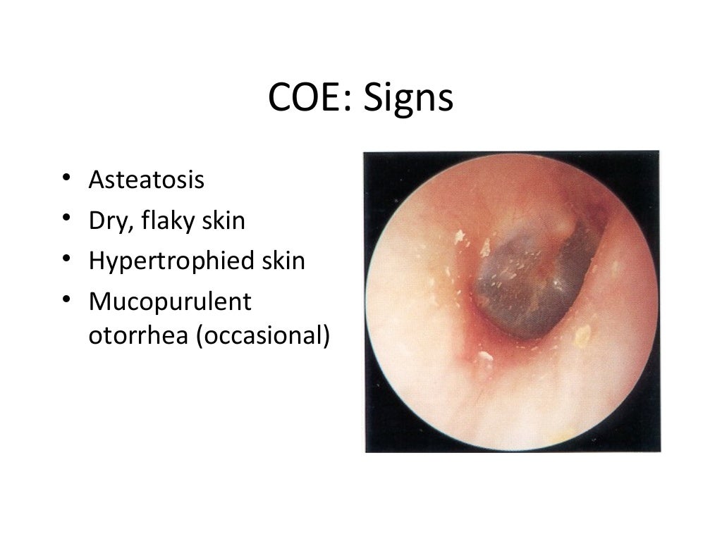 Infections of the external ear
