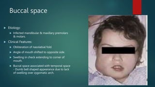 Infratemporal Space
 Boundaries:
 Superiorly: infratemporal surface of greater wing of
sphenoid.
 Inferiorly: lateral p...