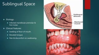 Secondary Fascial Spaces
 Masseteric Space
 Boundaries:
 Superiorly: zygomatic arch.
 Inferiorly: inferior border of m...