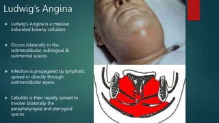 Ludwig’s Angina
 Clinically, the condition is characterized by:
 Painful bilateral swelling of floor of mouth and elevat...