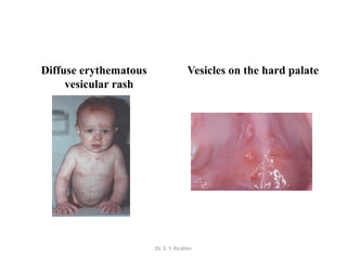 Infections of the oral mucosa.pptx in oral pathology | PPTX