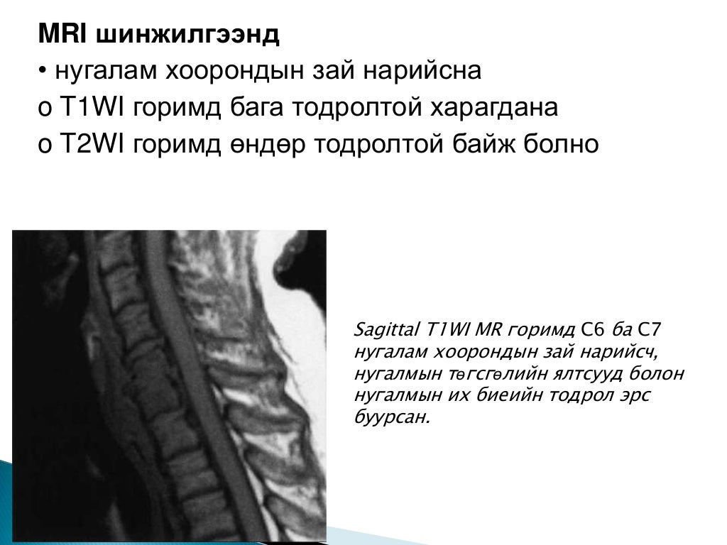 Багана нурууны халдварт эмгэгүүд сүүлийн
