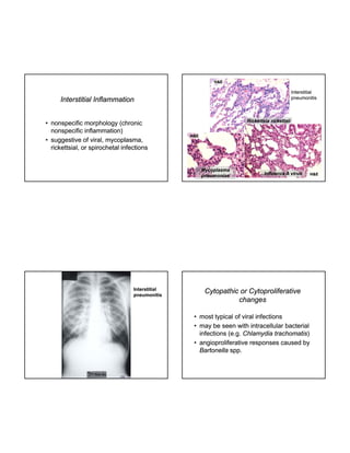 H&E

Interstitial
pneumonitis

Interstitial Inflammation
• nonspecific morphology (chronic
nonspecific inflammation)
• suggestive of viral, mycoplasma,
mycoplasma,
rickettsial, or spirochetal infections

Rickettsia rickettsii
H&E

Mycoplasma
pneumoniae

Interstitial
pneumonitis

Influenza A virus

Cytopathic or Cytoproliferative
changes
• most typical of viral infections
• may be seen with intracellular bacterial
infections (e.g. Chlamydia trachomatis)
trachomatis)
• angioproliferative responses caused by
Bartonella spp.

H&E

 