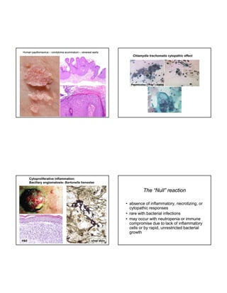 Human papillomavirus – condyloma acuminatum – venereal warts

Chlamydia trachomatis cytopathic effect

Papinicolou (“Pap”) stains

Cytoproliferative inflammation:
Bacillary angiomatosis- Bartonella henselae
angiomatosis-

The “Null” reaction
• absence of inflammatory, necrotizing, or
cytopathic responses
y
• rare with bacterial infections
• may occur with neutropenia or immune
compromise due to lack of inflammatory
cells or by rapid, unrestricted bacterial
growth
H&E

silver stain

 