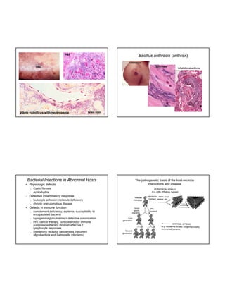 H&E

Bacillus anthracis (anthrax)
cutaneous
dura mater

Vibrio vulnificus with neutropenia

Gram stain

Bacterial Infections in Abnormal Hosts
• Physiologic defects






Cystic fibrosis
Achlorhydria

Defective inflammatory response




leukocyte adhesion molecule deficiency
chronic granulomatous disease

• Defects in immune function








inhalational anthrax

complement deficiency, asplenia, susceptibility to
encapsulated bacteria
hypogammaglobulinemia > defective opsonization
HIV, cancer therapy, corticosteroid or immune
suppressive therapy diminish effective T
lymphocyte responses
interferon- receptor deficiencies (recurrent
Mycobacteria and Salmonella infections)

The pathogenetic basis of the host-microbe
interactions and disease

 