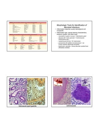 Morphologic Tools for Identification of
Microbial Infections
• inflammatory response usually stereotypical and
nonspecific
• inflammation type, special staining characteristics,
anatomic location, and other clues










neutrophils in gastric mucosa > Helicobacter pylori
abscess with “sulfur granules” > Actinomycosis
(Actinomyces spp.)
caseating granulomas > M. tuberculosis
granulomas with stellate microabscesses > cat
scratch disease (Bartonella henselae)
lymphocytic vasculitis > Rocky Mountain spotted fever
(Rickettsia rickettsii)

silver stain

H&E

Gram stain

sulfur granule

H&E

Helicobacter pylori gastritis

actinomycosis

 