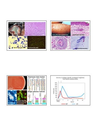 H&E

Caseous necrosis in TB

H&E

Sputum acid fast stain

Fluorochrome stain

Rocky Mountain spotted fever

lymphocytic vasculitis

H&E

Polymerase chain reaction

immunohistochemistry

Detection of antigen-specific serological responses
Post-infection antibody kinetics

1800
1600

Antigen detection methods

Antibody titer
y

1400

culture

1200
1000
800
600
400
200

H. pylori in situ
hybridization

S. aureus PNA FISH
(peptide(peptide-nucleic acid
fluorescence in situ
hybridization)

0
Onset of
illness

1

6

12

18

Months

IgM

IgG

24

 