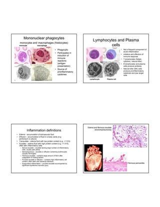 Mononuclear phagocytes
monocytes and macrophages (histiocytes)
monocyte

macrophage

Lymphocytes and Plasma
cells
•

• Phagocytic
• Participates in
induction of
immune
reactions
(antigen
presentation)
• Source of
proinflammatory
cytokines

•
•
•
•

Lymphocyte

Inflammation definitions
•
•
•
•

Not a frequent component of
acute inflammation
initiators and effectors of
immune response
T lymphocytes (
(helper,
cytotoxic, natural killer)
B lymphocytes and plasma
cells produce antibody
Natural killer (NK) cells
produce proinflammatory
cytokines and lyse target
cells

Plasma cell

Edema and fibrinous exudate
(bronchopneumonia)

Edema – accumulation of extrvascular fluid
Effusion – accumulation of fluid in a body cavity (e.g.
peritoneum or pleura)
Transudate – edema fluid with low protein content (s.g. <1.015)
Exudate – edema fluid with high protein content (s.g. >1.015),
often with inflammatory cells
– Serous exudate – exudate lacking large number of inflammatory
g g
y
cells; usually pale yellow
– Serosanguinous – exudate or effusion containing erythrocytes
(usually red-tinged)
– Fibrinous exudate – contains large amount of fibrin after
coagulation of clotting factors
– Purulent exudate or effusion – contains high inflammatory cell
content; often seen with bacterial infections
– Suppurative inflammation – purulent exudate accompanied by
significant liquifactive necrosis (pus).

Fibrinous pericarditis

 