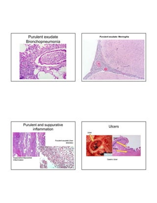 Purulent exudate
Bronchopneumonia

Purulent exudate: Meningitis

Purulent and suppurative
inflammation

Ulcers
Ulcer
Ulcer

Purulent exudate (liver
abscess)
Artery

Suppurative Myocardial
Inflammation

Gastric Ulcer

 