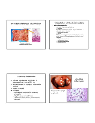 Pseudomembranous Inflammation

Histopathology with bacterial infections
• Extracellular bacteria
– Incite acute inflammation with edema

Pseudomembrane

• exudative

– Depending upon bacterial species, may cause necrosis 
suppuration (pus) or abscess
• exudative with necrosis
• abscess

– With time, increasing chronic i fl
ti
i
i
h i inflammation b i l di
ti begins leading
various degrees of mixed acute and chronic inflammation
– Examples:

Pseudomembranous
(Clostridium difficile) colitis
difficile)

•
•
•
•

Streptococcus pneumoniae
Staphylococcus aureus
Pseudomonas aeruginosa
Most other bacteria

Exudative Inflammation
• vascular permeability, recruitment of
leukocytes (esp. neutrophils), pus
• typically caused by pyogenic, extracellular
bacteria
• usually localized
• examples:






group A strep (Streptococcus pyogenes)
(Streptococcus pyogenes)
pharyngitis
Staphylococcus aureus furuncle
Streptococcus pneumoniae pneumonia and
meningitis

Exudative
Inflammation

Streptococcal pharyngitis
(strep throat)

 