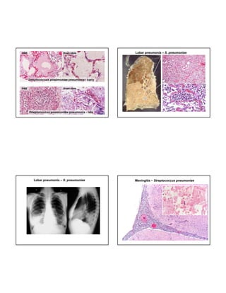 Lobar pneumonia – S. pneumoniae

Lobar pneumonia – S. pneumoniae

Meningitis – Streptococcus pneumoniae

 