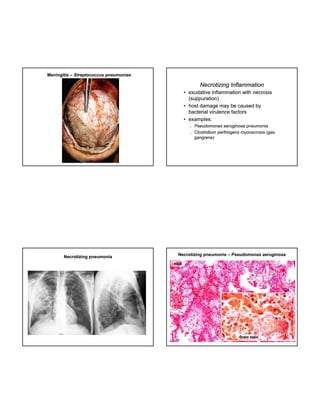 Meningitis – Streptococcus pneumoniae

Necrotizing Inflammation
• exudative inflammation with necrosis
(suppuration)
• host damage may be caused by
bacterial virulence factors
• examples:




Necrotizing pneumonia

Pseudomonas aeruginosa pneumonia
Clostridium perfringens myonecrosis (gas
gangrene)

Necrotizing pneumonia – Pseudomonas aeruginosa
H&E

Gram stain

 