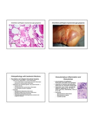 Clostridium perfringens myonecrosis (gas gangrene)

Clostridium perfringens myonecrosis (gas gangrene)

Gram stain

Histopathology with bacterial infections
• Facultative and obligate intracellular bacteria
– Incite chronic inflammation  acute inflammation
• chronic inflammation or mixed acute and chronic inflammation
• granulomas or granulomatous inflammation

– Depending upon bacterial species, may cause necrosis 
• caseous necrosis
g
• microabcesses within granulomatous inflammation
• host cell-specific necrosis or apoptosis
cell-

– Examples:
•
•
•
•

Mycobacterium tuberculosis (tuberculosis)
Rickettsia rickettsii (Rocky Mountain spotted fever)
Mycoplasma pneumoniae pneumonitis
Chlamydia trachomatis (lymphogranuloma venereum and
urogenital infections)

Granulomatous Inflammation and
Granulomas
• accumulations of epithelioid
histiocytes (activated macrophages)
• response to bacteria that withstand
destruction by neutrophil phagocytes
• dependent upon intact, appropriate
p
p
, pp p
cytokine responses (IL-1, IFN-,
(ILIFNCXCL and CCL chemokines, not IL-4
ILor IL-10)
IL• examples:






Mycobacterium tuberculosis
Mycobacterium leprae
Coxiella burnetii

 