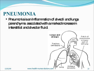 PNEUMONIA Pneumonia is an Inflammation of alveoli and lungs parenchyma  associated with a marked increase in interstitial and alveolar fluid.  06/07/09 www.health-nurses-doctors.com 