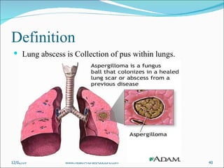 Definition Lung abscess is Collection of pus within lungs. 06/07/09 www.health-nurses-doctors.com 
