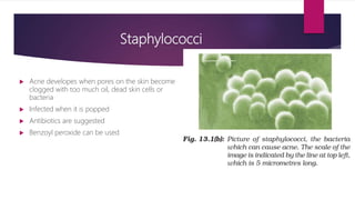 Staphylococci
 Acne developes when pores on the skin become
clogged with too much oil, dead skin cells or
bacteria
 Infected when it is popped
 Antibiotics are suggested
 Benzoyl peroxide can be used
 