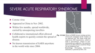 SEVERE ACUTE RESPIRATORY SYNDROME
 Corona virus
 Appeared in China in Nov 2002.
 Within few months, spread worldwide,
carried by unsuspecting travellers
 Collaborative international effort allowed
health experts to quickly contain the spread of
disease.
 No known transmission of SARS anywhere
in the world wide since 2004.
 