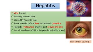 Hepatitis
 Viral disease
 Primarily involves liver
 Caused by hepatitis virus
 Acute infection of the liver and results in jaundice
 Hepatitis- yellowness of white part of eyes and skin
 Jaundice- release of bilirubin (gets deposited in sclera)
Learn with Saro (youtube)
 