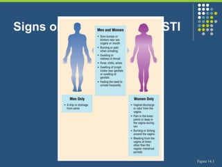 Signs or Symptoms of an STI
Figure 14.3
 