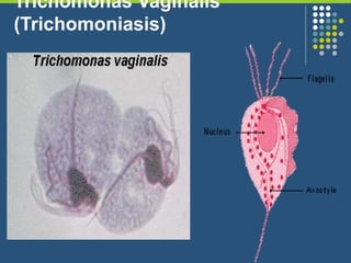 Trichomonas Vaginalis
(Trichomoniasis)
 