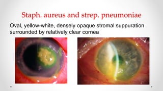 Staph. aureus and strep. pneumoniae
Oval, yellow-white, densely opaque stromal suppuration
surrounded by relatively clear cornea
 
