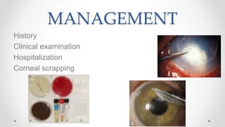 MANAGEMENT
History
Clinical examination
Hospitalization
Corneal scrapping
 
