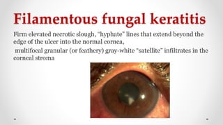 Filamentous fungal keratitis
Firm elevated necrotic slough, “hyphate” lines that extend beyond the
edge of the ulcer into the normal cornea,
multifocal granular (or feathery) gray-white “satellite” infiltrates in the
corneal stroma
 