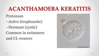 ACANTHAMOEBA KERATITIS
Protozoan
–Active (trophozoite)
–Dormant (cystic)
Common in swimmers
and CL wearers
 