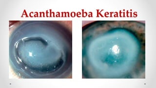 Acanthamoeba Keratitis
 