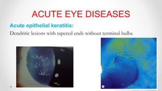 ACUTE EYE DISEASES
Acute epithelial keratitis:
Dendritic lesions with tapered ends without terminal bulbs
 
