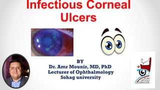 Infectious Corneal
Ulcers
 