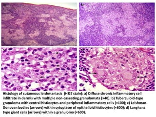 .




Histology of cutaneous leishmaniasis (H&E stain): a) Diffuse chronic inflammatory cell
infiltrate in dermis with multiple non-caseating granulomata (×40); b) Tuberculoid-type
granuloma with central histiocytes and peripheral inflammatory cells (×100); c) Leishman-
Donovan bodies (arrows) within cytoplasm of epithelioid histiocytes (×600); d) Langhans
type giant cells (arrows) within a granuloma (×600).
 