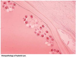 Histopathology of hydatid cyst.
 