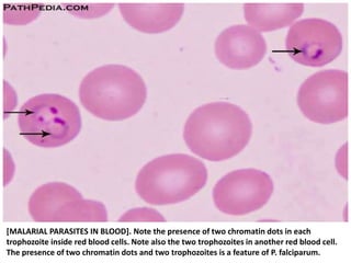 [MALARIAL PARASITES IN BLOOD]. Note the presence of two chromatin dots in each
trophozoite inside red blood cells. Note also the two trophozoites in another red blood cell.
The presence of two chromatin dots and two trophozoites is a feature of P. falciparum.
 