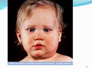 Infectious disease in children nurs 3340 | PPTX