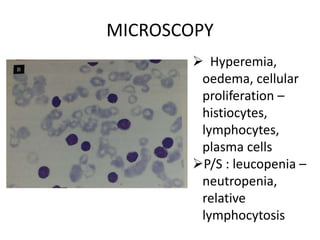MICROSCOPY
 Hyperemia,
oedema, cellular
proliferation –
histiocytes,
lymphocytes,
plasma cells
P/S : leucopenia –
neutropenia,
relative
lymphocytosis
 