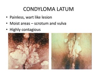 CONDYLOMA LATUM
• Painless, wart like lesion
• Moist areas – scrotum and vulva
• Highly contagious
 
