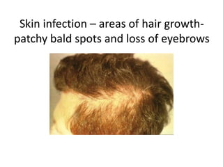 Skin infection – areas of hair growth-
patchy bald spots and loss of eyebrows
 
