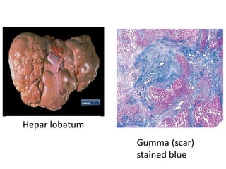 Gumma (scar)
stained blue
Hepar lobatum
 