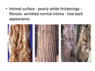 • Intimal surface - pearly white thickenings -
fibrosis- wrinkled normal intima - tree bark
appearance.
 