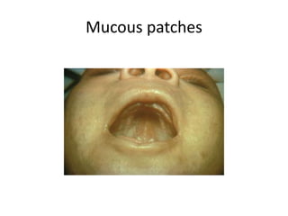 Mucous patches
 