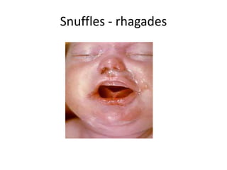 Snuffles - rhagades
 